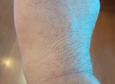 FORM Hand Therapy