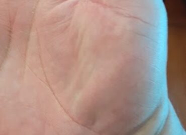 FORM Hand Therapy